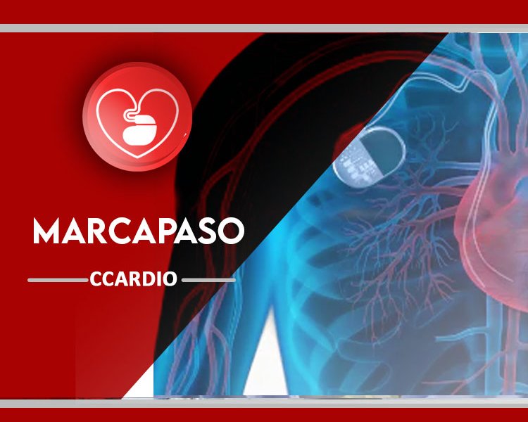 Marcapaso