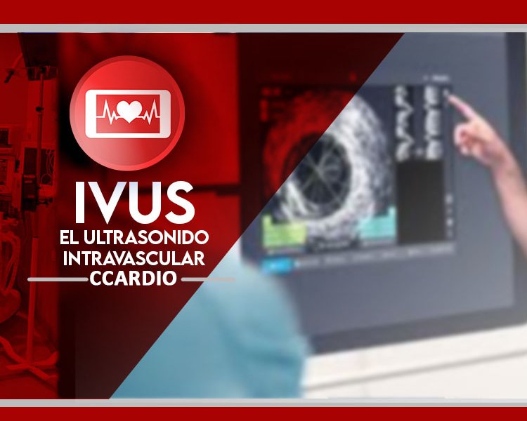 ivus